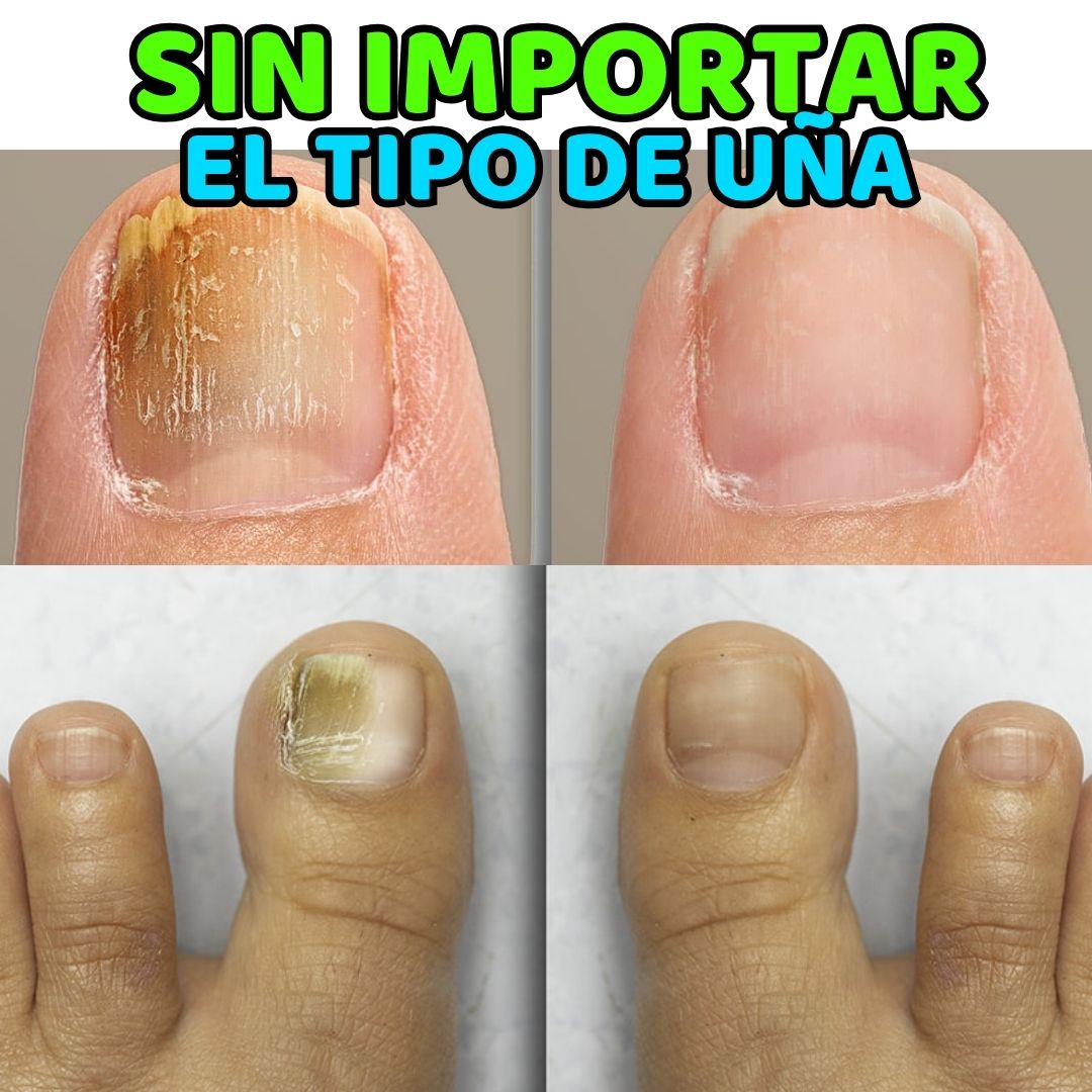 ¡Di adiós a los hongos de una vez por todas!