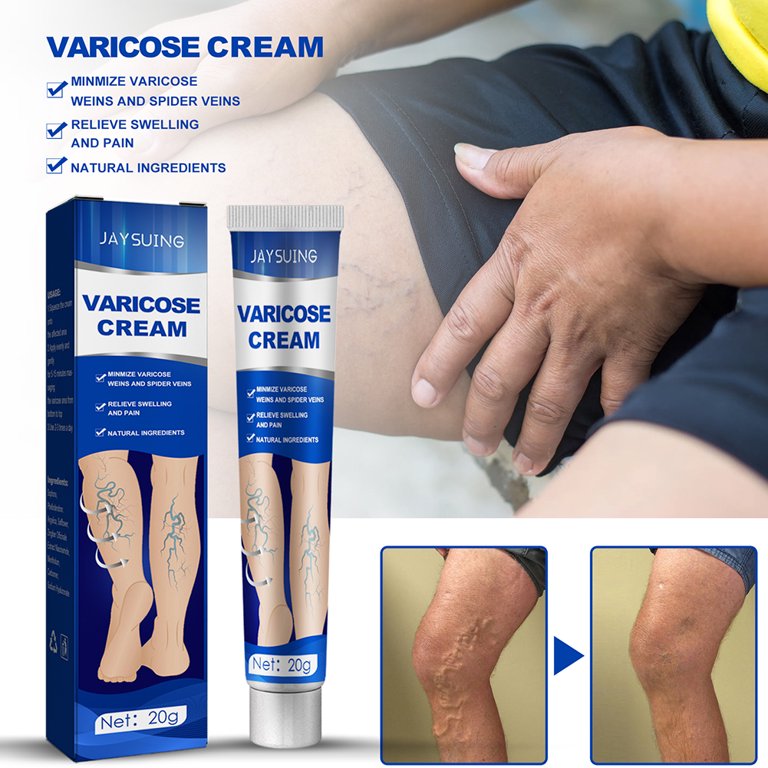 ✨¡Dile adiós a las molestias de las venas varicosas con nuestra Crema Especializada para Venas Varicosas y Arañas Vasculares!