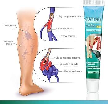 ✨¡Dile adiós a las molestias de las venas varicosas con nuestra Crema Especializada para Venas Varicosas y Arañas Vasculares!