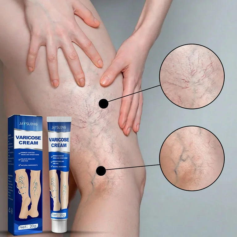 ✨¡Dile adiós a las molestias de las venas varicosas con nuestra Crema Especializada para Venas Varicosas y Arañas Vasculares!