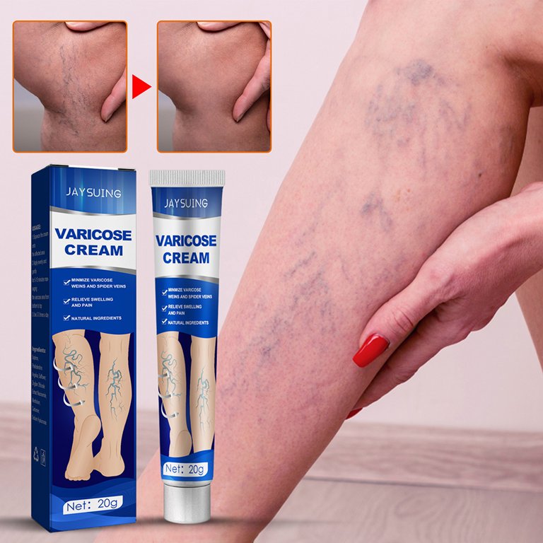 ✨¡Dile adiós a las molestias de las venas varicosas con nuestra Crema Especializada para Venas Varicosas y Arañas Vasculares!